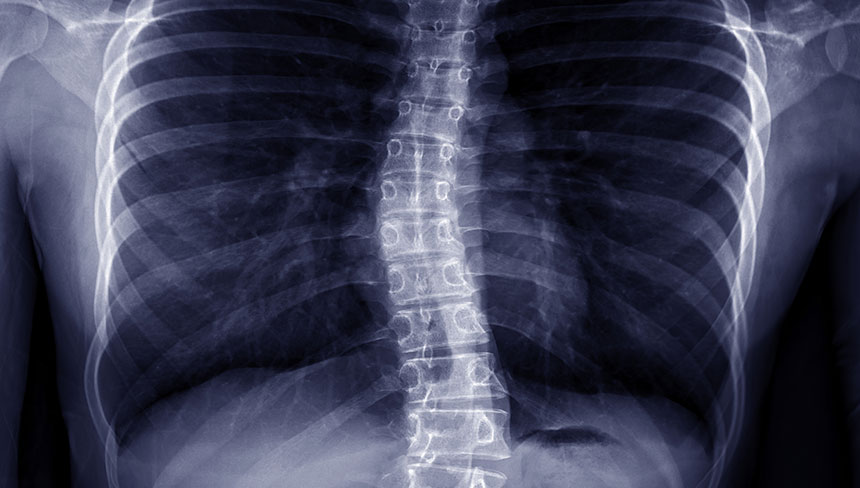 patient needing scoliosis treatment in Campbell