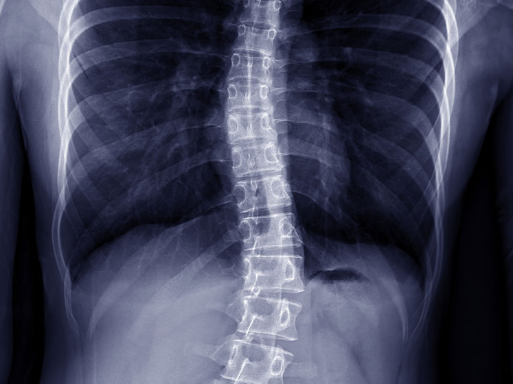 scoliosis treatment in Campbell
