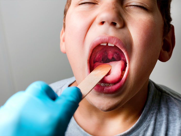 tonsillitis treatment in Campbell